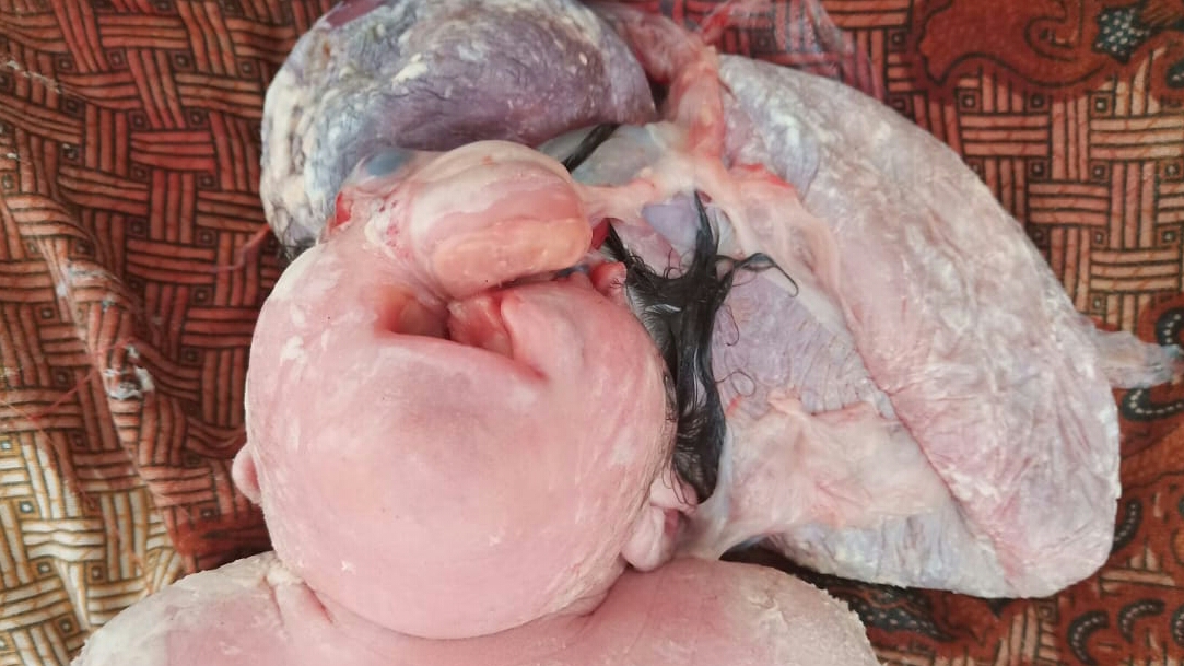 Bayi yang lahir dengan kelainan Anenchepali