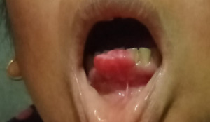 Direktur RSU Tapsel Bantu Biaya Operasi Tumor Warga Madina